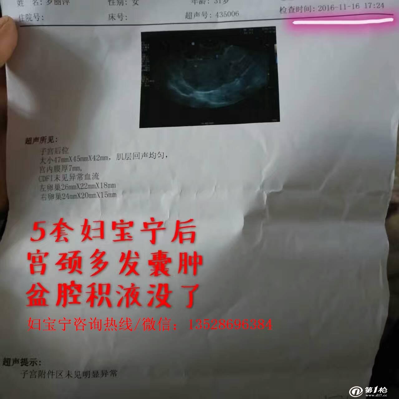 宫颈多发囊肿盆腔积液用宁密康原妇宝宁调理好案例