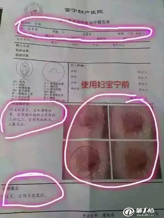 霉菌性阴道炎宫颈糜烂盆腔积液用宁密康原妇宝宁调理好案例