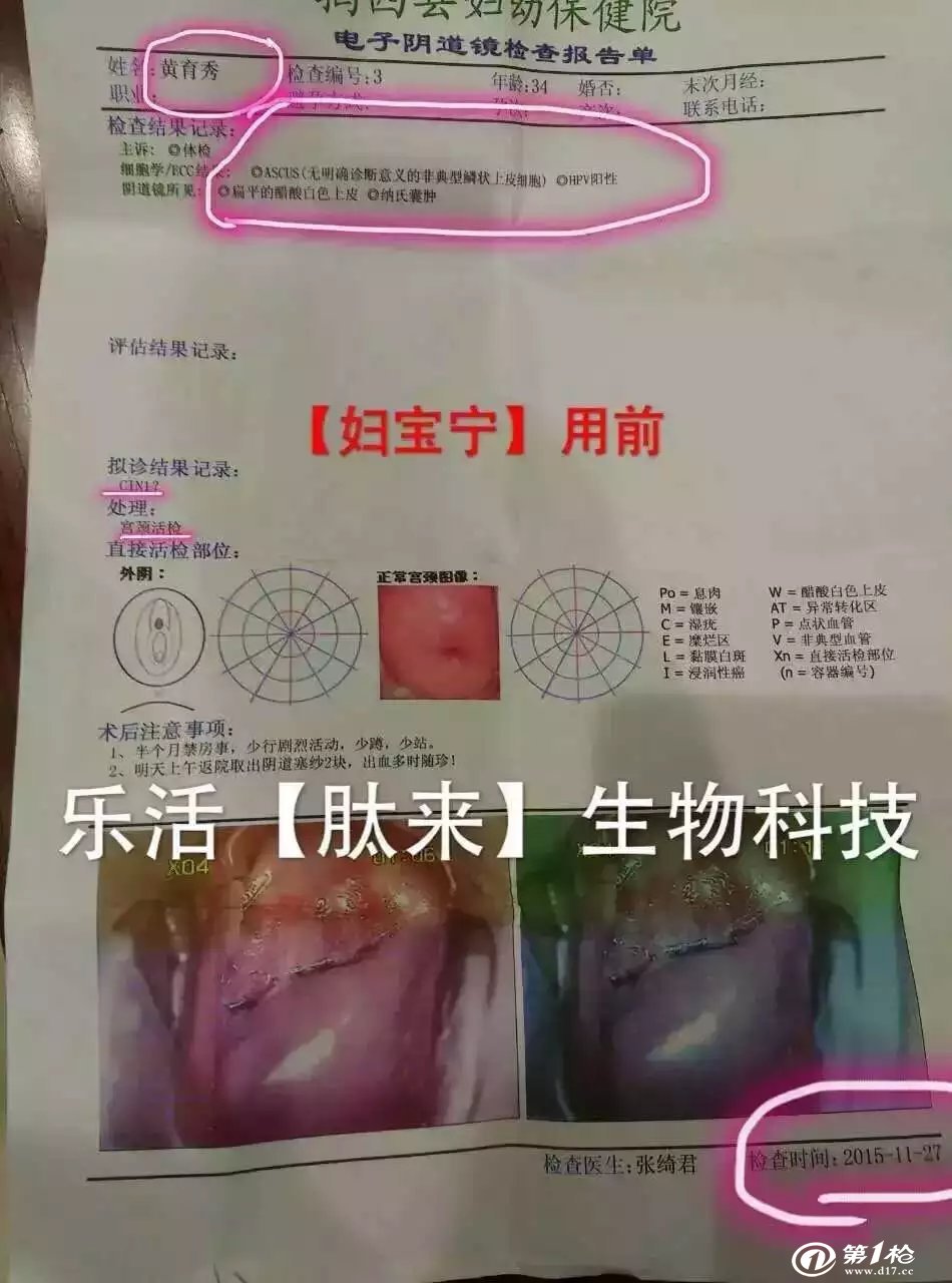 18型别引起的宫颈癌,又能预防感染hpv6,11型别引发的生殖器疣