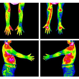 TC-5全身性热成像检查