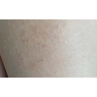 10岁小孩皮肤经常痒，皮肤像起了疹子一样，应该如何改善？