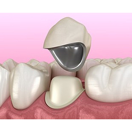 胶托义齿普通支架 义齿牙义齿义齿加工义齿