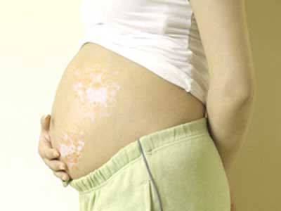 孕期患上白癜风是什么因素导致的?